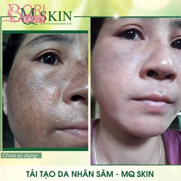 trải nghiệm trước và sau khi dùng thay da nhân sâm mq skin