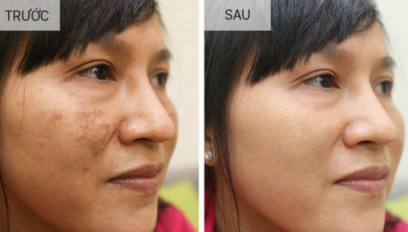 Làn da cải thiện sau khi sử dụng Kem Face Hà Kiều Anh