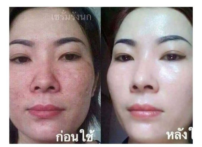 Giúp da bớt đỏ, giảm mụn, và khỏe mạnh hơn
