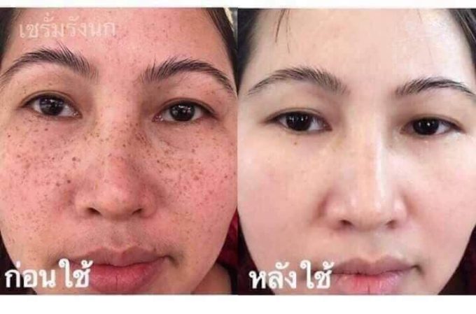 Nám dày đặc cũng có thể được cải thiện đáng kể