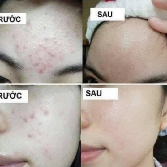 Hình ảnh trước và sau khi sử dụng