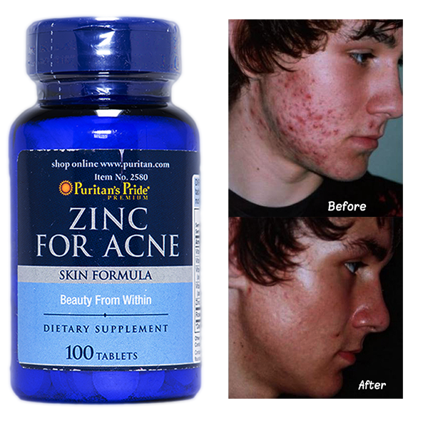 review Viên Kẽm Trị Mụn Zinc For Acne