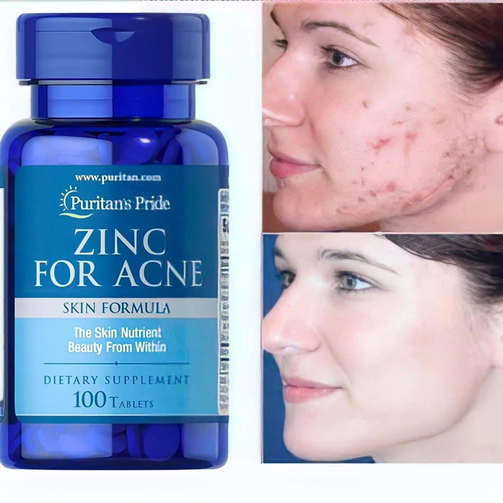 Viên Kẽm Trị Mụn Zinc For Acne Puritan’s Pride 100 Viên Của Mỹ – Hàng Chính Hãng